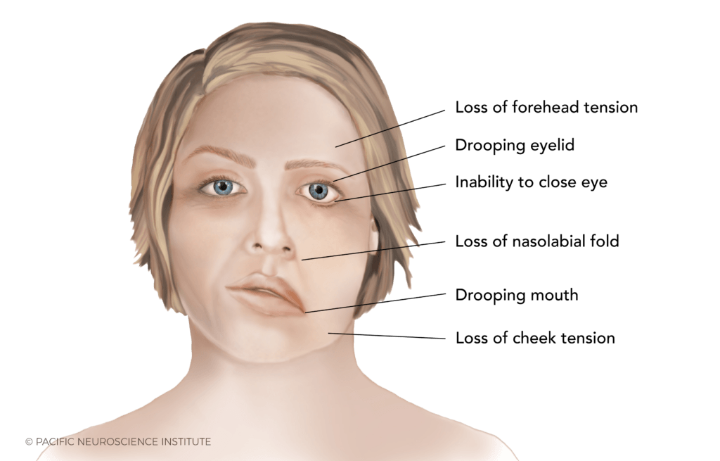 งูสวัด Shingles Ramsay Hunt Syndrome พีคอสเมด Pcosmed ศูนย์รวมโซลูชั่นด้านผิวหนังครบวงจร