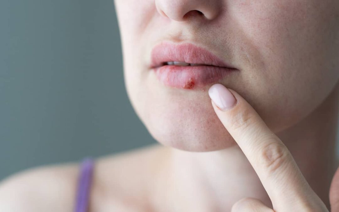 เริม (Herpes simplex) คืออะไร มีกี่ชนิด?