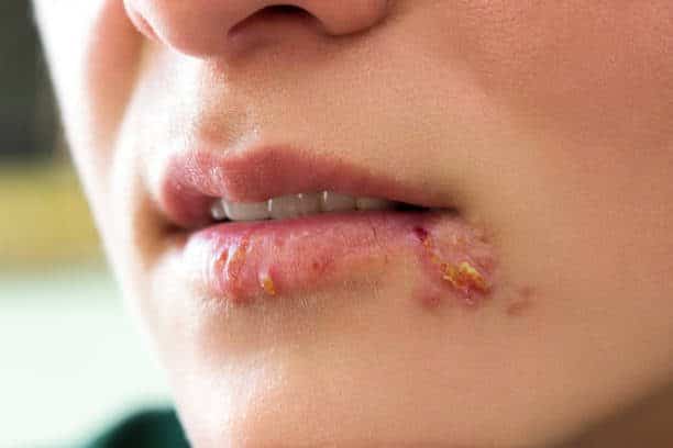 Herpes Simplex คือ เริม พีคอสเมด Pcosmed ศูนย์รวมโซลูชั่นด้านผิวหนังครบวงจร