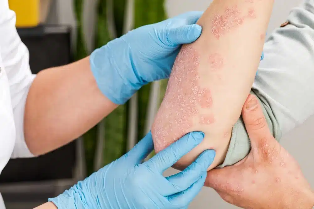 สะเก็ดเงิน (Psoriasis) มีวิธีการรักษาอย่างไร?