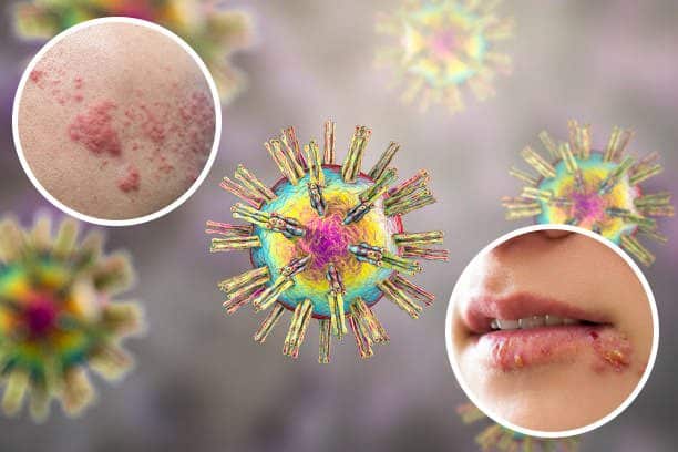 Herpes ในทางการแพทย์ หมายถึง เม็ด ตุ่ม กับ เม็ดกลุ่ม พีคอสเมด Pcosmed ศูนย์รวมโซลูชั่นด้านผิวหนังครบวงจร