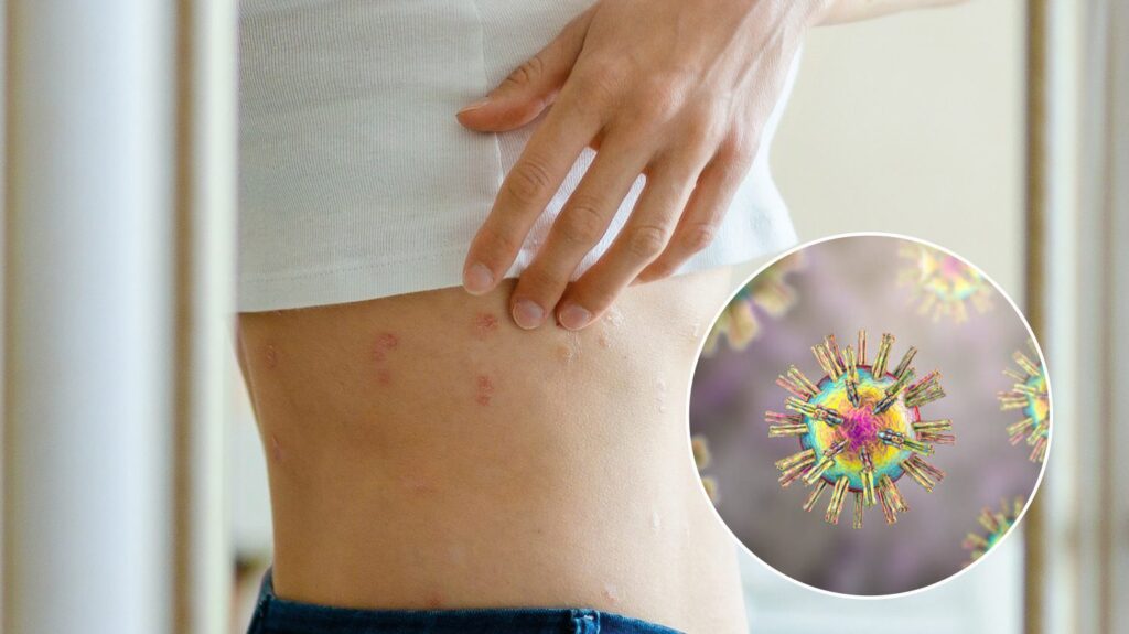 งูสวัด Shingles โรคผิวหนังชนิดหนึ่งที่เกิดจากเชื้อไวรัส Varicella Zoster Virus VZV พีคอสเมด Pcosmed ศูนย์รวมโซลูชั่นด้านผิวหนังครบวงจร
