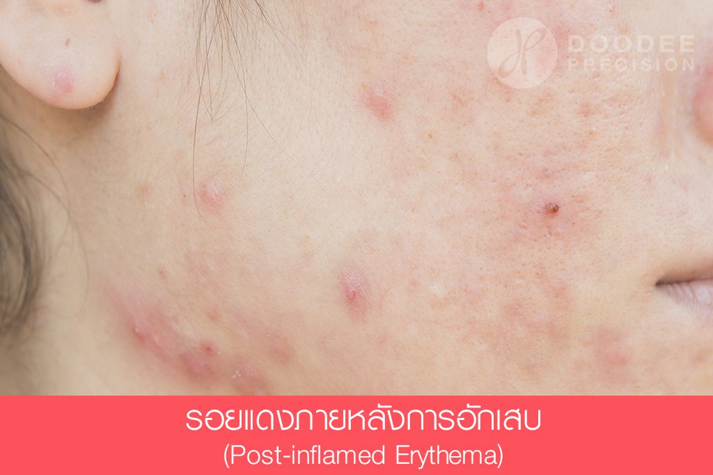 พีคอสเมด Pcosmed ศูนย์รวมโซลูชั่นด้านผิวหนังครบวงจร