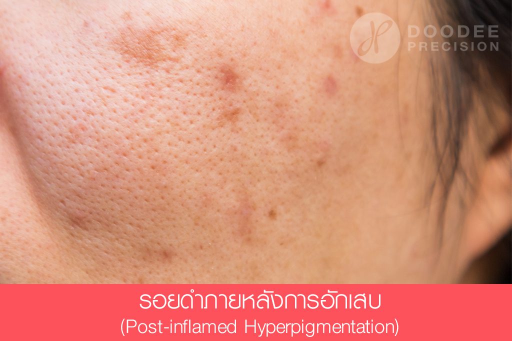 พีคอสเมด Pcosmed ศูนย์รวมโซลูชั่นด้านผิวหนังครบวงจร