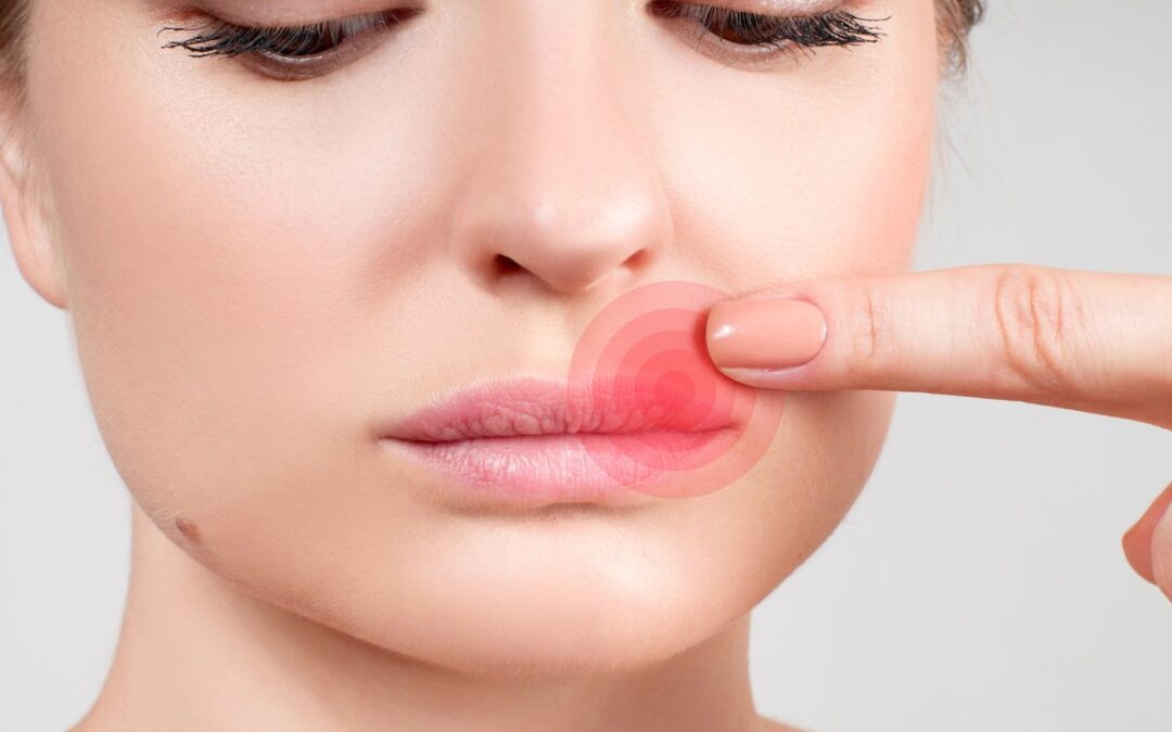 เริม (Herpes simplex) มีอาการอย่างไร?