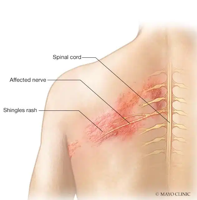 งูสวัด Shingles Shingles affects the nerves พีคอสเมด Pcosmed ศูนย์รวมโซลูชั่นด้านผิวหนังครบวงจร