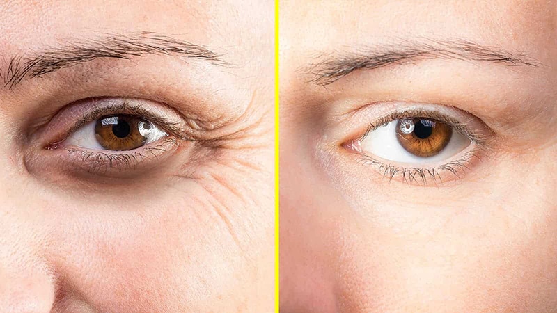 หยุด 6 พฤติกรรมเพิ่มรอยตีนกา ถุงใต้ตาบวม พีคอสเมด Pcosmed ศูนย์รวมโซลูชั่นด้านผิวหนังครบวงจร