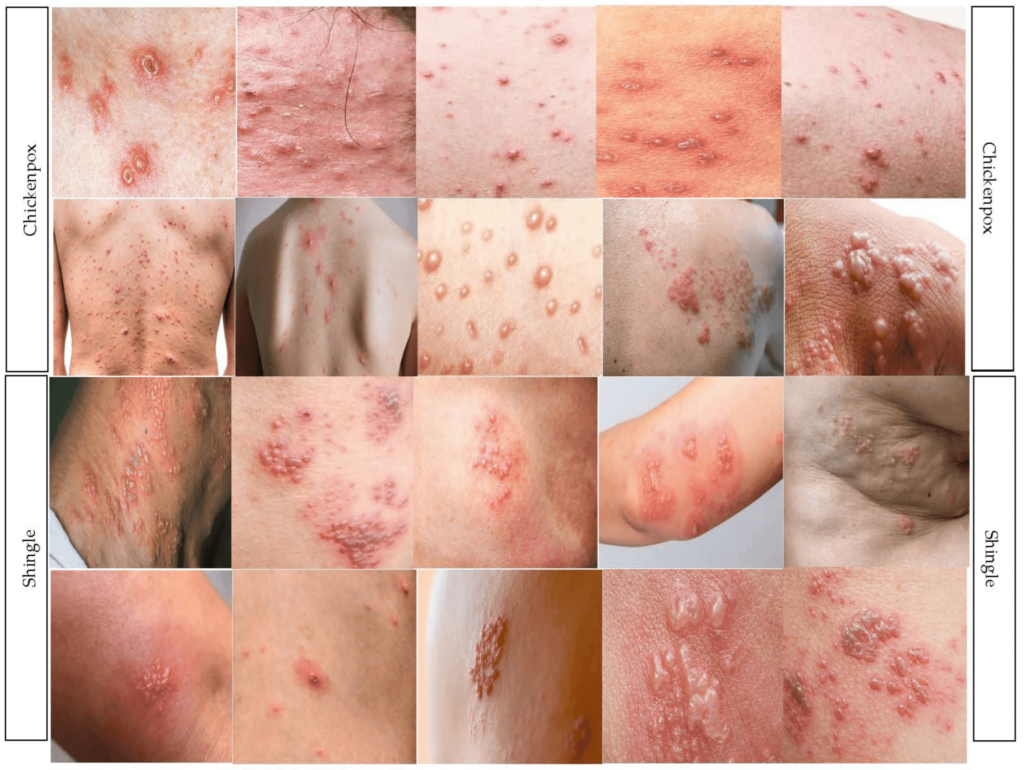 งูสวัด Shingles และ อีสุกอีใส Chickenpox พีคอสเมด Pcosmed ศูนย์รวมโซลูชั่นด้านผิวหนังครบวงจร