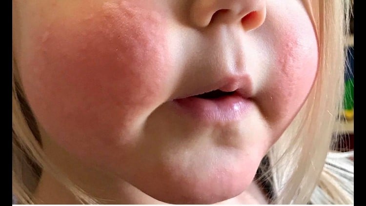 ภูมิแพ้ความเย็นในเด็ก พีคอสเมด Pcosmed ศูนย์รวมโซลูชั่นด้านผิวหนังครบวงจร