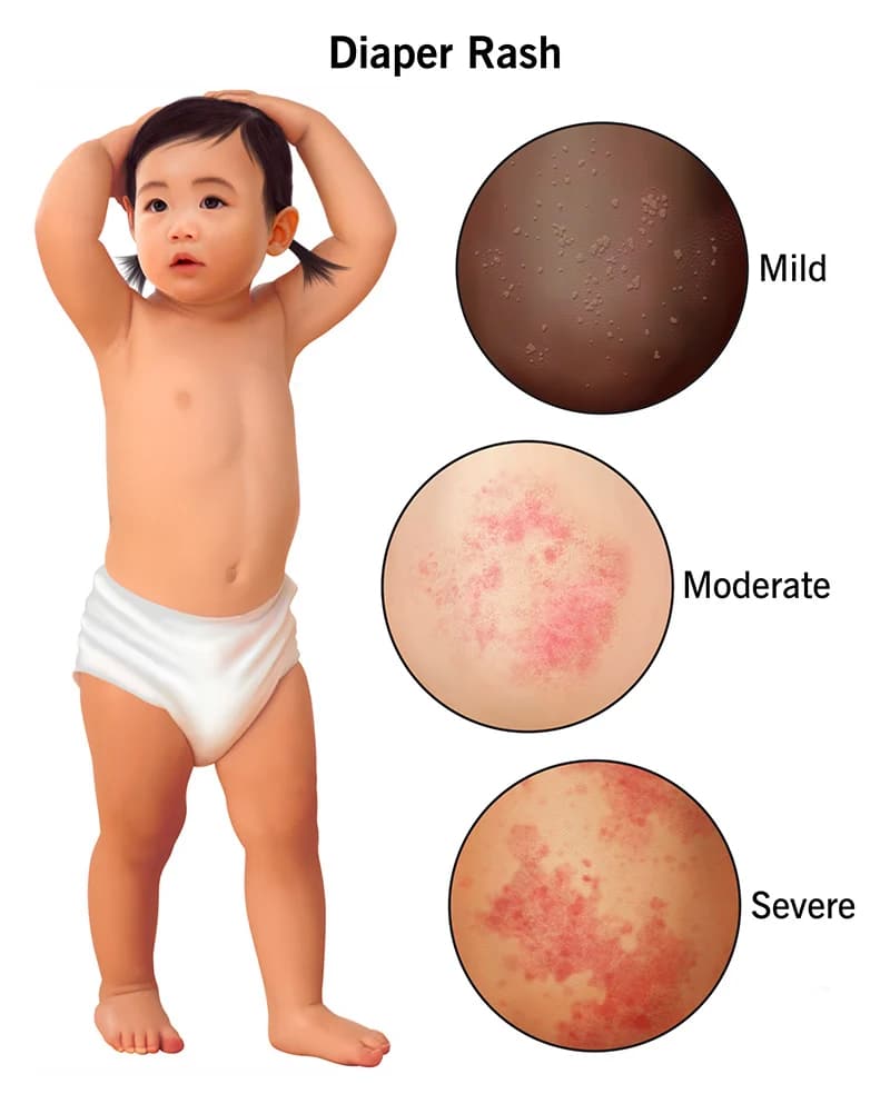 ผื่นผ้าอ้อมกัดในเด็กและผู้สูงวัย Diaper Rash พีคอสเมด Pcosmed ศูนย์รวมโซลูชั่นด้านผิวหนังครบวงจร