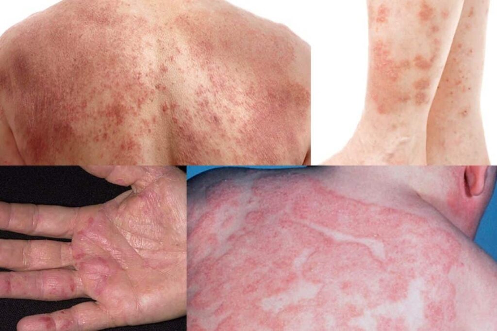 ผื่นภูมิแพ้ Atopic Dermatitis พีคอสเมด Pcosmed ศูนย์รวมโซลูชั่นด้านผิวหนังครบวงจร