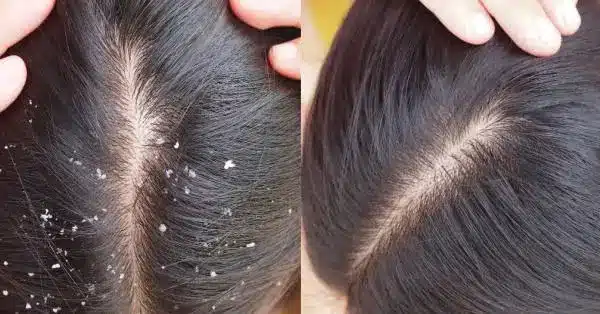 รังแคไม่จำเป็นต้องพบแพทย์ เพราะสามารถรักษาได้ด้วยตนเอง พีคอสเมด Pcosmed ศูนย์รวมโซลูชั่นด้านผิวหนังครบวงจร