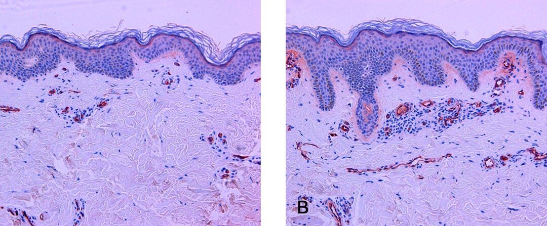 The vascular characteristics of melasma