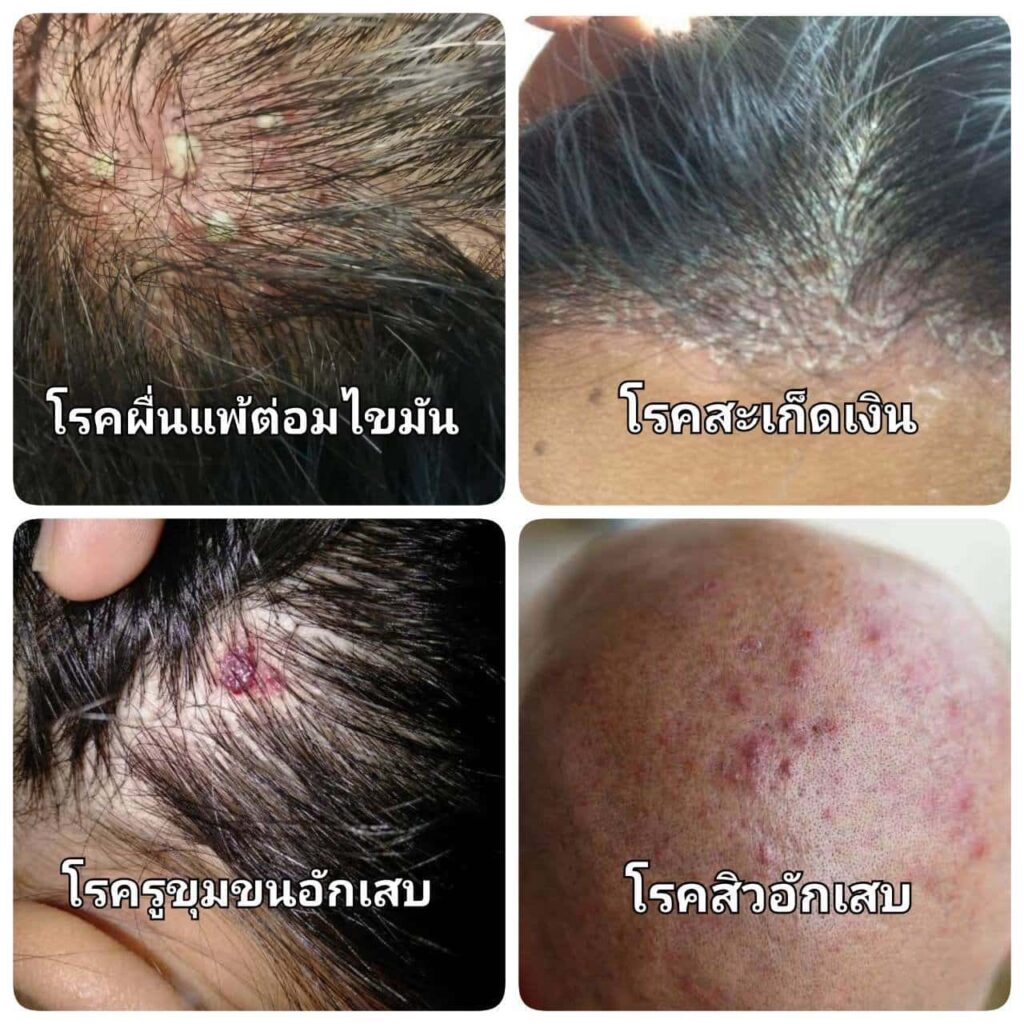 อาการตุ่มขึ้นบนศีรษะมีน้ำเหลืองอาจจะเกิดจากรูขุมขนอักเสบ พีคอสเมด Pcosmed ศูนย์รวมโซลูชั่นด้านผิวหนังครบวงจร