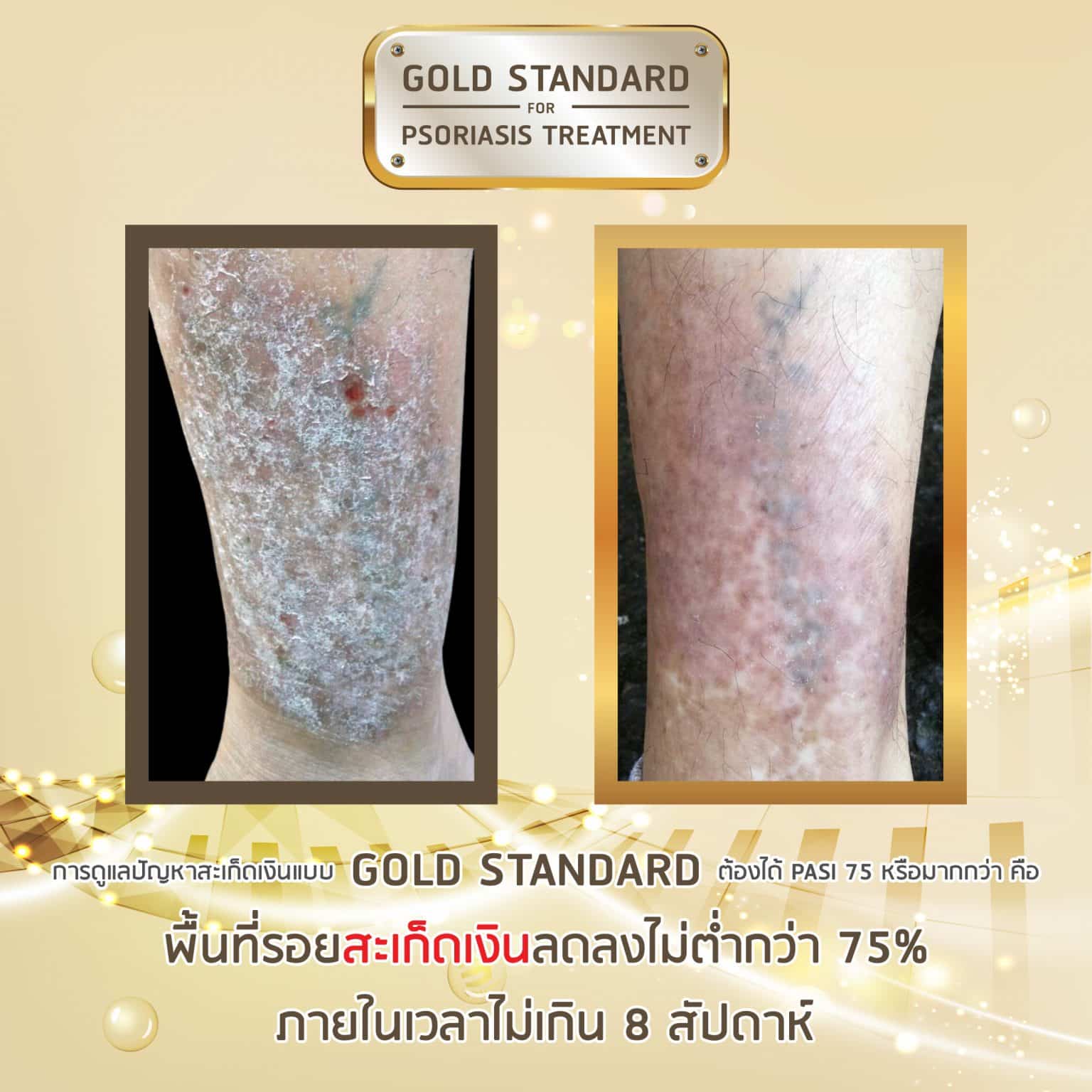 psoriasisbannermb02 พีคอสเมด Pcosmed ศูนย์รวมโซลูชั่นด้านผิวหนังครบวงจร พีคอสเมด Pcosmed ศูนย์รวมโซลูชั่นด้านผิวหนังครบวงจร