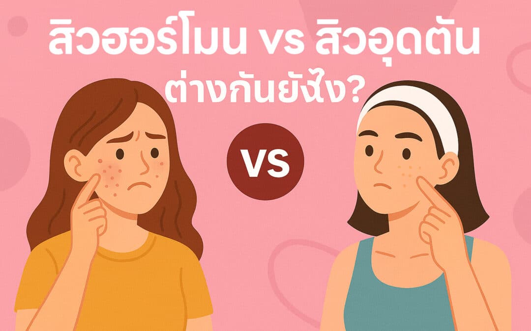 สิวฮอร์โมน vs สิวอุดตัน ต่างกันยังไง?