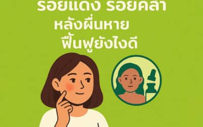 รอยแดง รอยคล้ำหลังผื่นหาย ฟื้นฟูยังไงดี