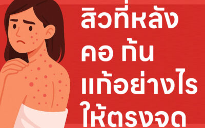 สิวที่หลัง คอ ก้น แก้อย่างไรให้ตรงจุด