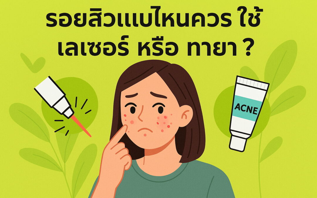 รอยสิวแบบไหนควรใช้เลเซอร์หรือทายา?