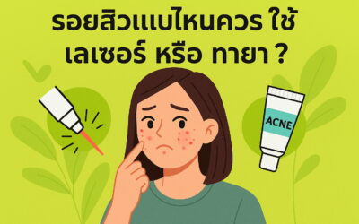 รอยสิวแบบไหนควรใช้เลเซอร์หรือทายา?